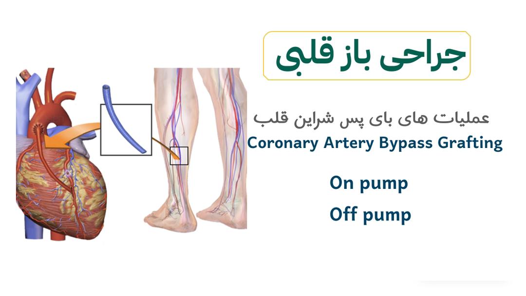 عملیات های بای پس شراین قلب